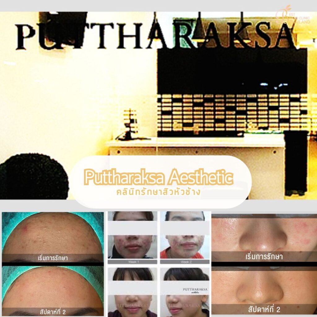 รักษาสิวหัวช้างที่ Puttharaksa Aesthetic