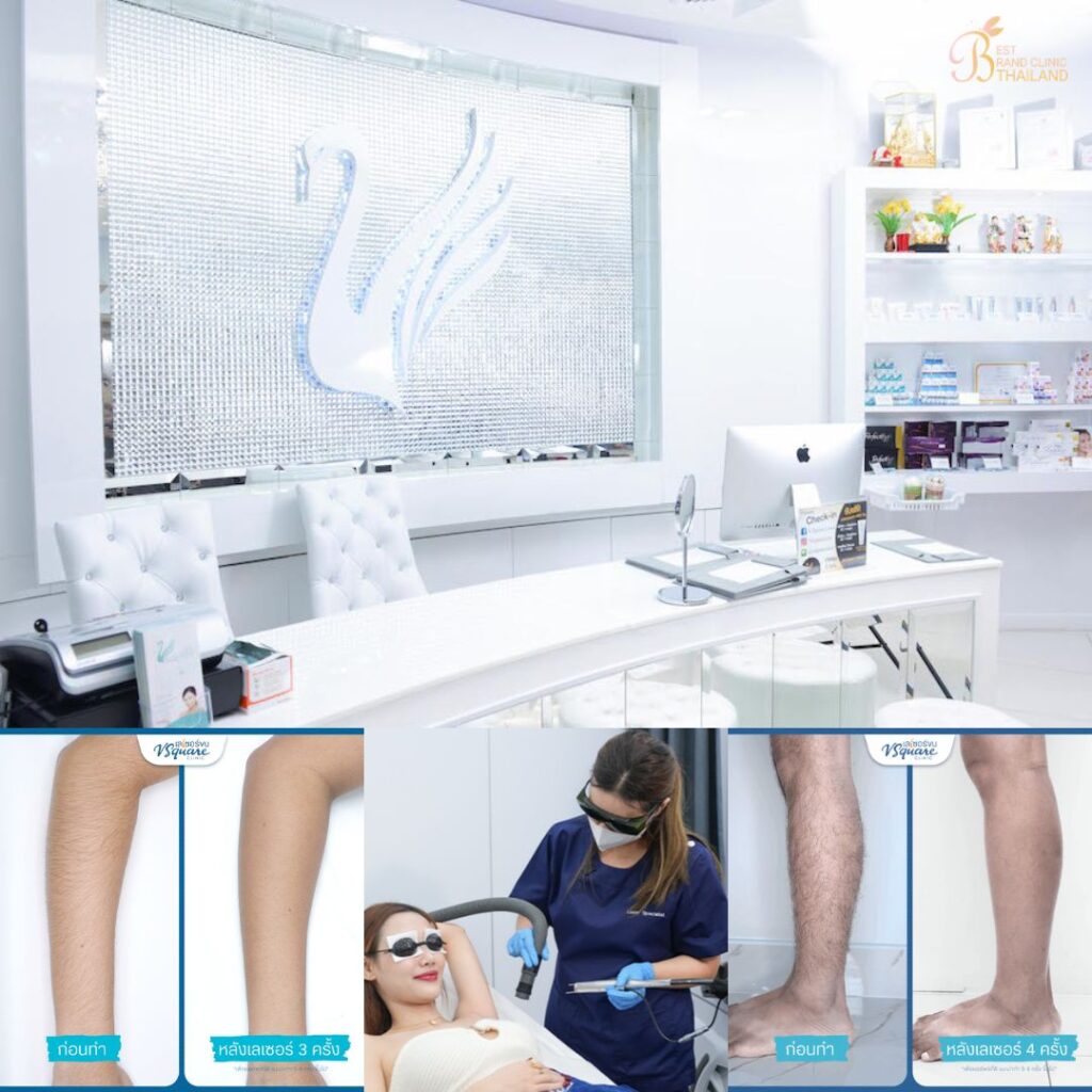 เลเซอร์ขนที่ V Square Clinic