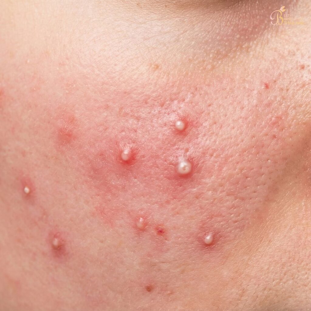 สิวหัวช้างคืออะไร?