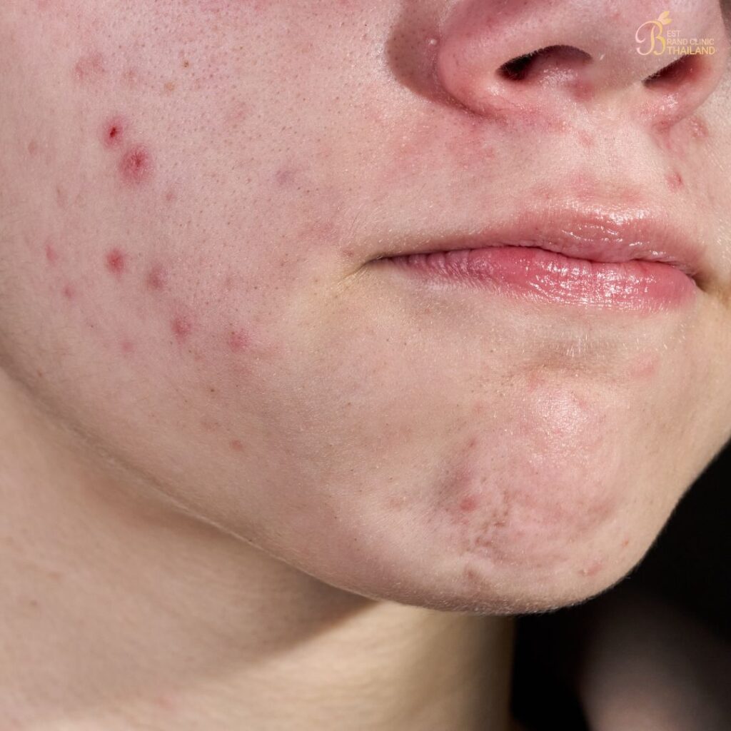 สิวหัวช้างเกิดจากอะไร