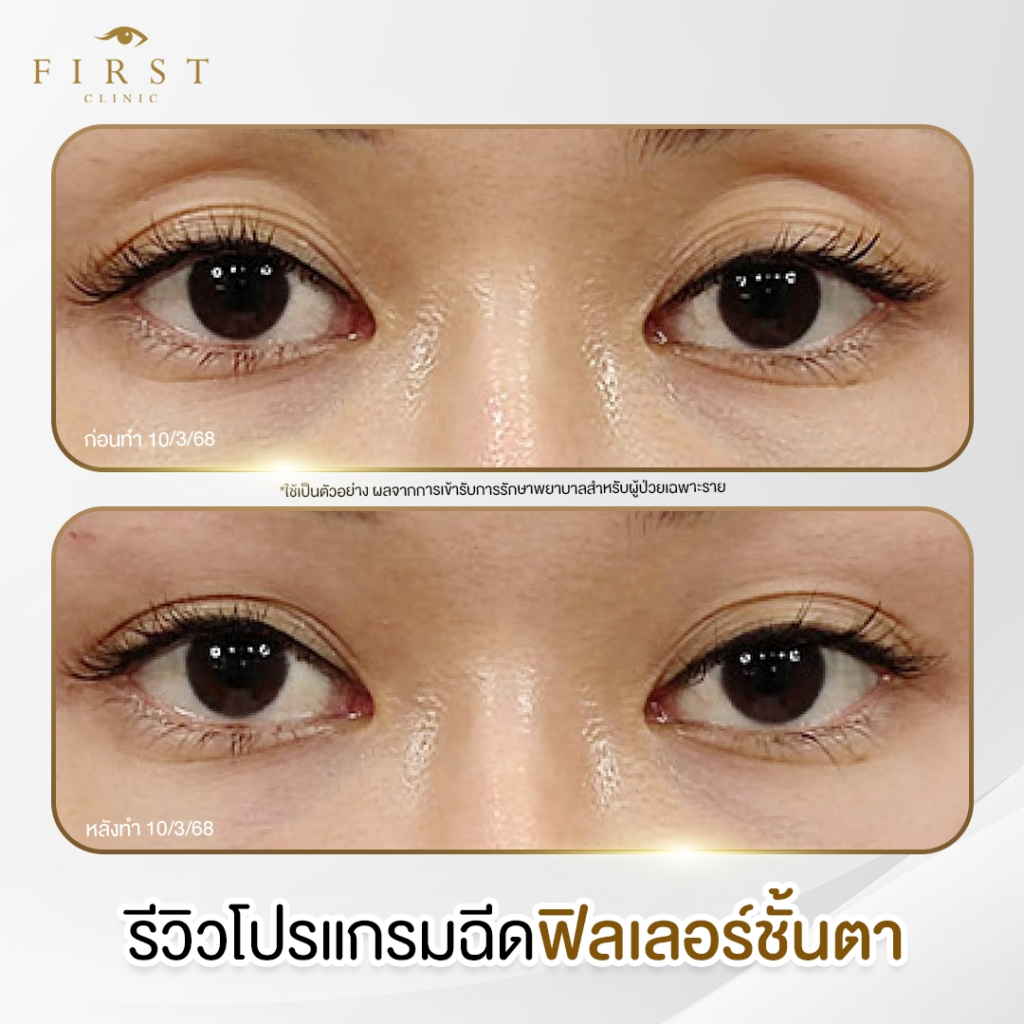 รีวิวฉีดฟิลเลอร์ใต้ตาที่ First Clinic