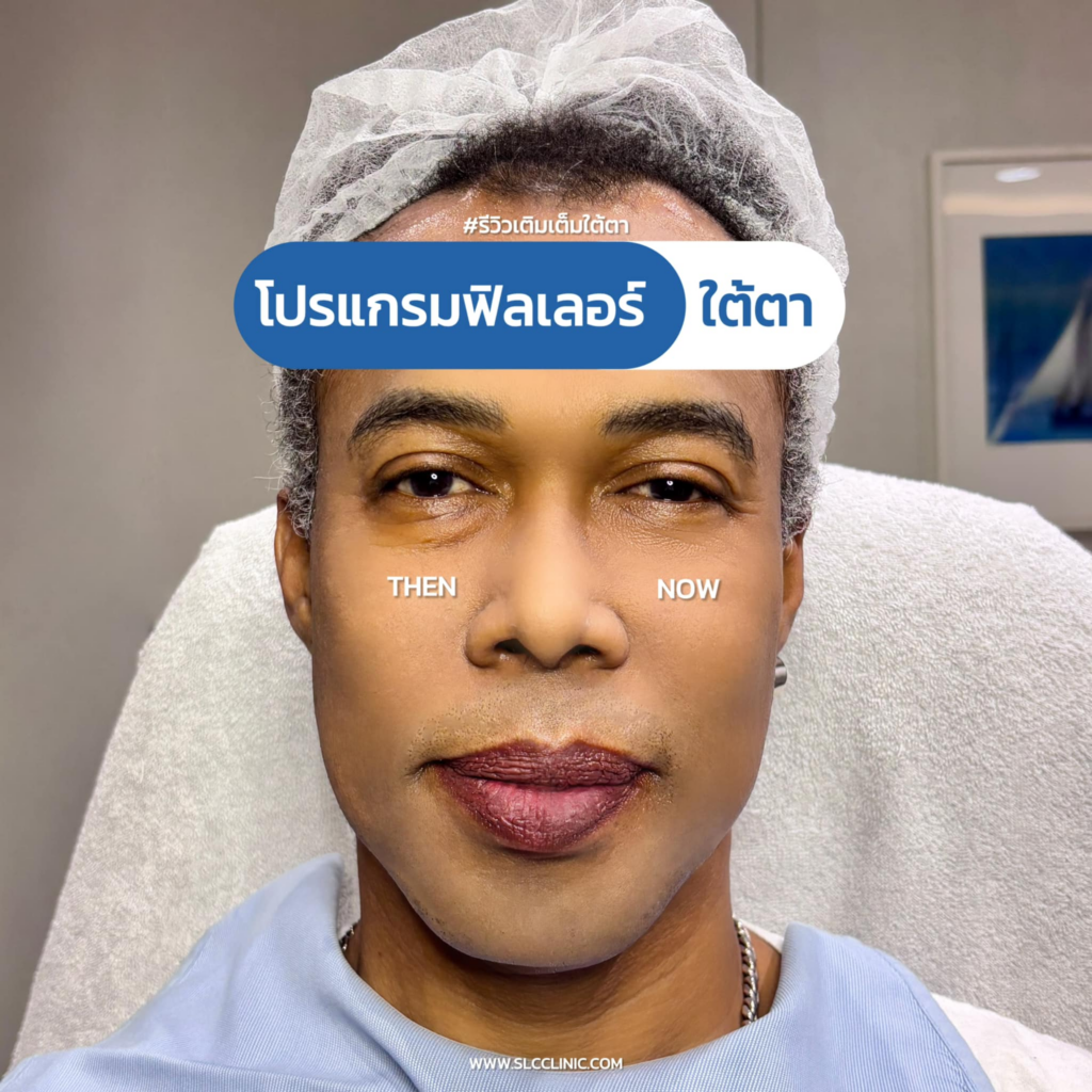 รีวิวฉีดฟิลเลอร์ใต้ตาที่ SLC Clinic