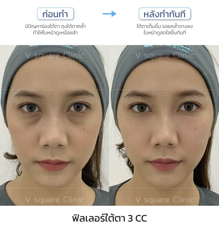 รีวิวฉีดฟิลเลอร์ใต้ตาที่ V Square Clinic