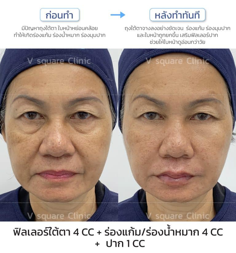 รีวิวฉีดฟิลเลอร์ใต้ตาที่ V Square Clinic