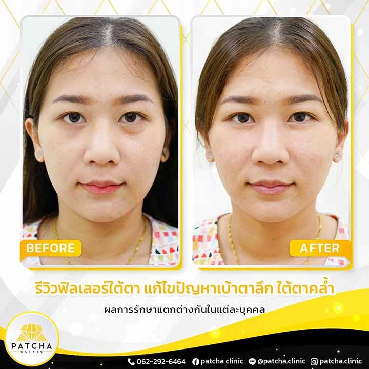 รีวิวฉีดฟิลเลอร์ใต้ตาที่ Patcha Clinic