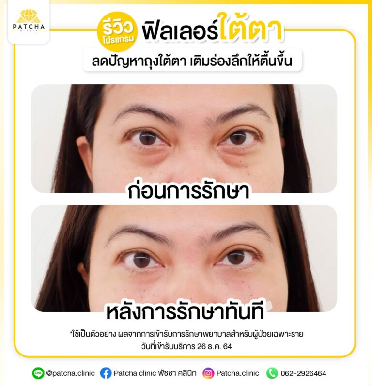 รีวิวฉีดฟิลเลอร์ใต้ตาที่ Patcha Clinic
