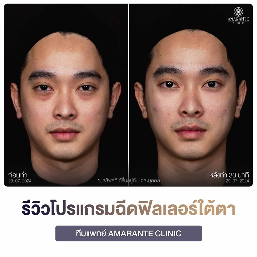 รีวิวฉีดฟิลเลอร์ใต้ตาที่ Amarante Clinic