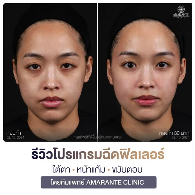 รีวิวฉีดฟิลเลอร์ใต้ตาที่ Amarante Clinic