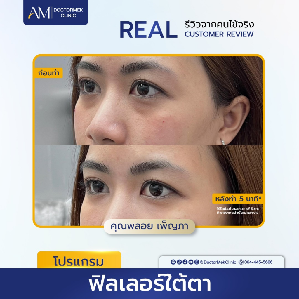 รีวิวฉีดฟิลเลอร์ใต้ตาที่ Doctor Mek Clinic
