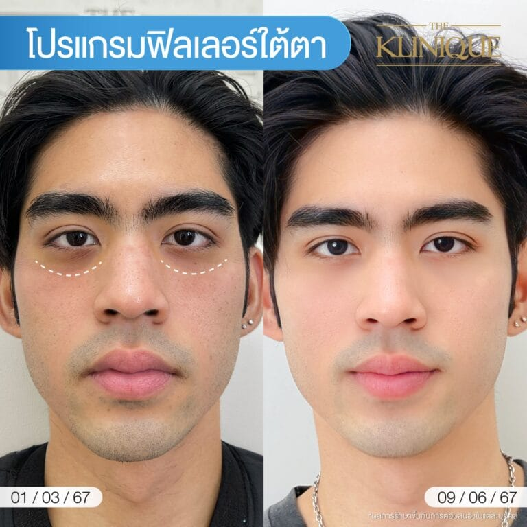 รีวิวฉีดฟิลเลอร์ใต้ตาที่ The Klinique
