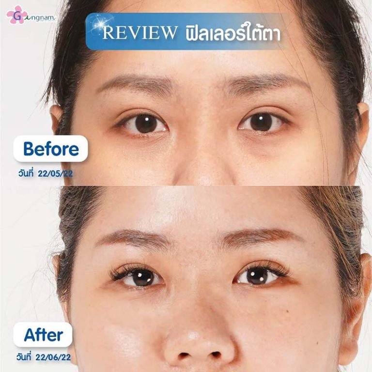 รีวิวฉีดฟิลเลอร์ใต้ตาที่ Gangnam Clinic