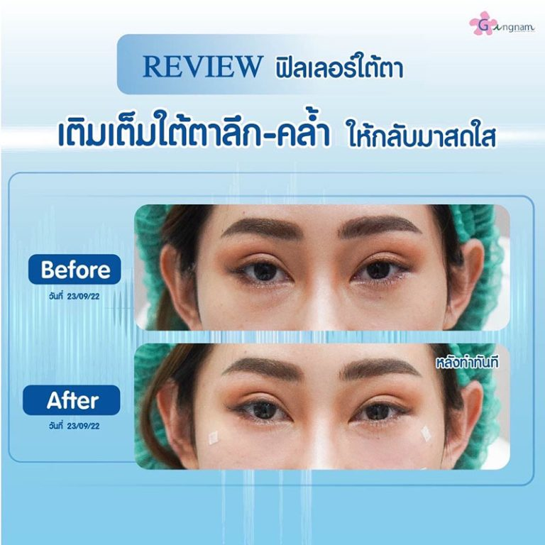 รีวิวฉีดฟิลเลอร์ใต้ตาที่ Gangnam Clinic