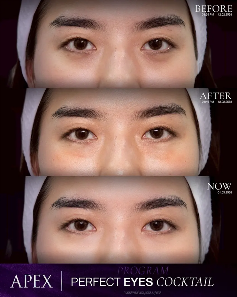 รีวิวฉีดฟิลเลอร์ใต้ตาที่ Apex Medical Center