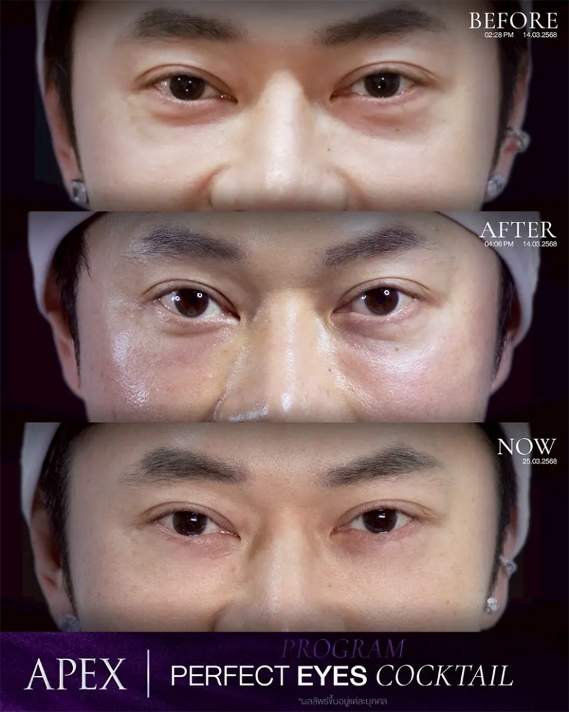 รีวิวฉีดฟิลเลอร์ใต้ตาที่ Apex Medical Center