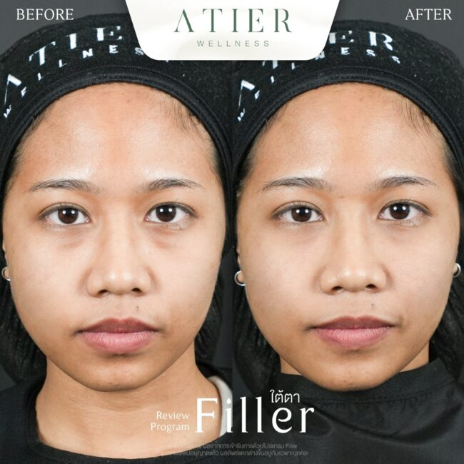 รีวิวฉีดฟิลเลอร์ใต้ตาที่ Atier Clinic