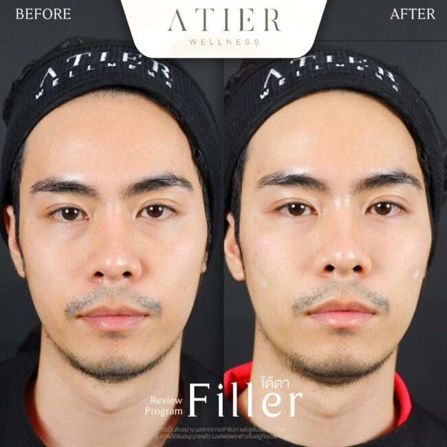 รีวิวฉีดฟิลเลอร์ใต้ตาที่ Atier Clinic