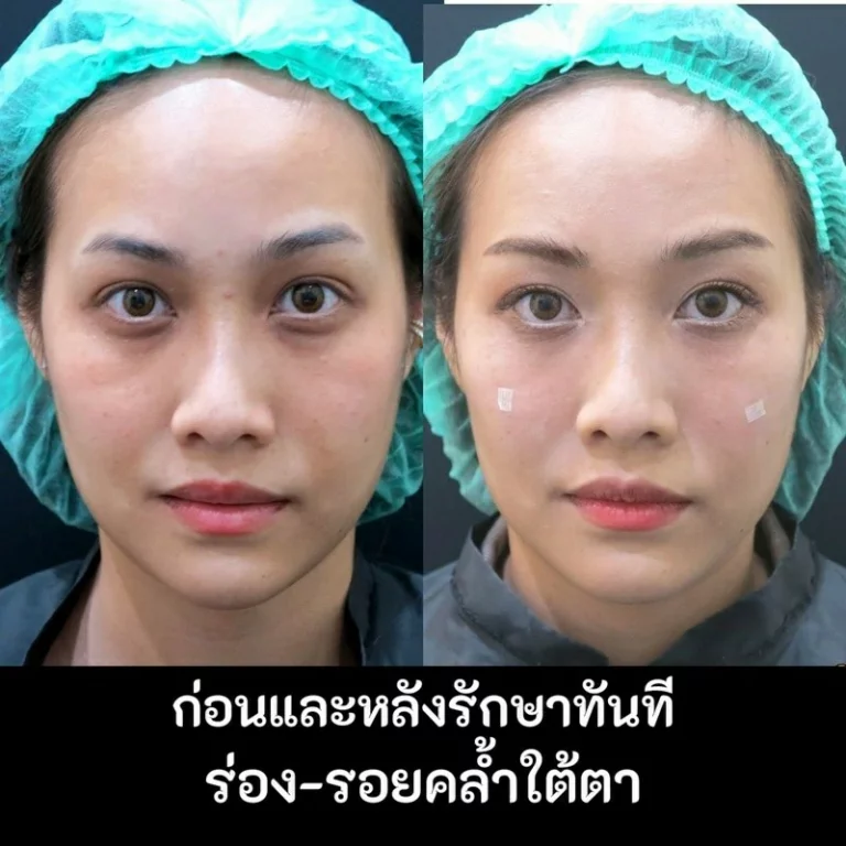 รีวิวฉีดฟิลเลอร์ใต้ตาที่ AIC Clinic