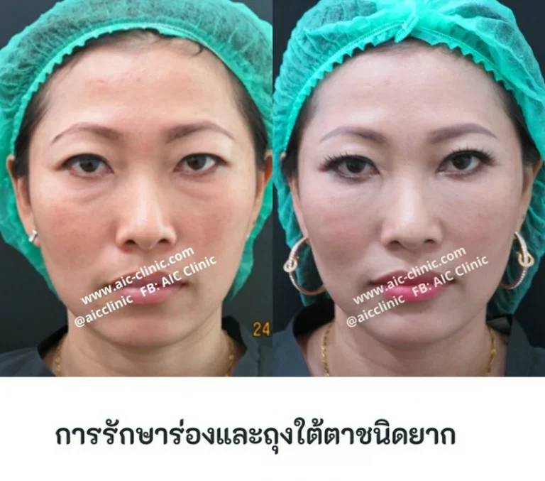 รีวิวฉีดฟิลเลอร์ใต้ตาที่ AIC Clinic
