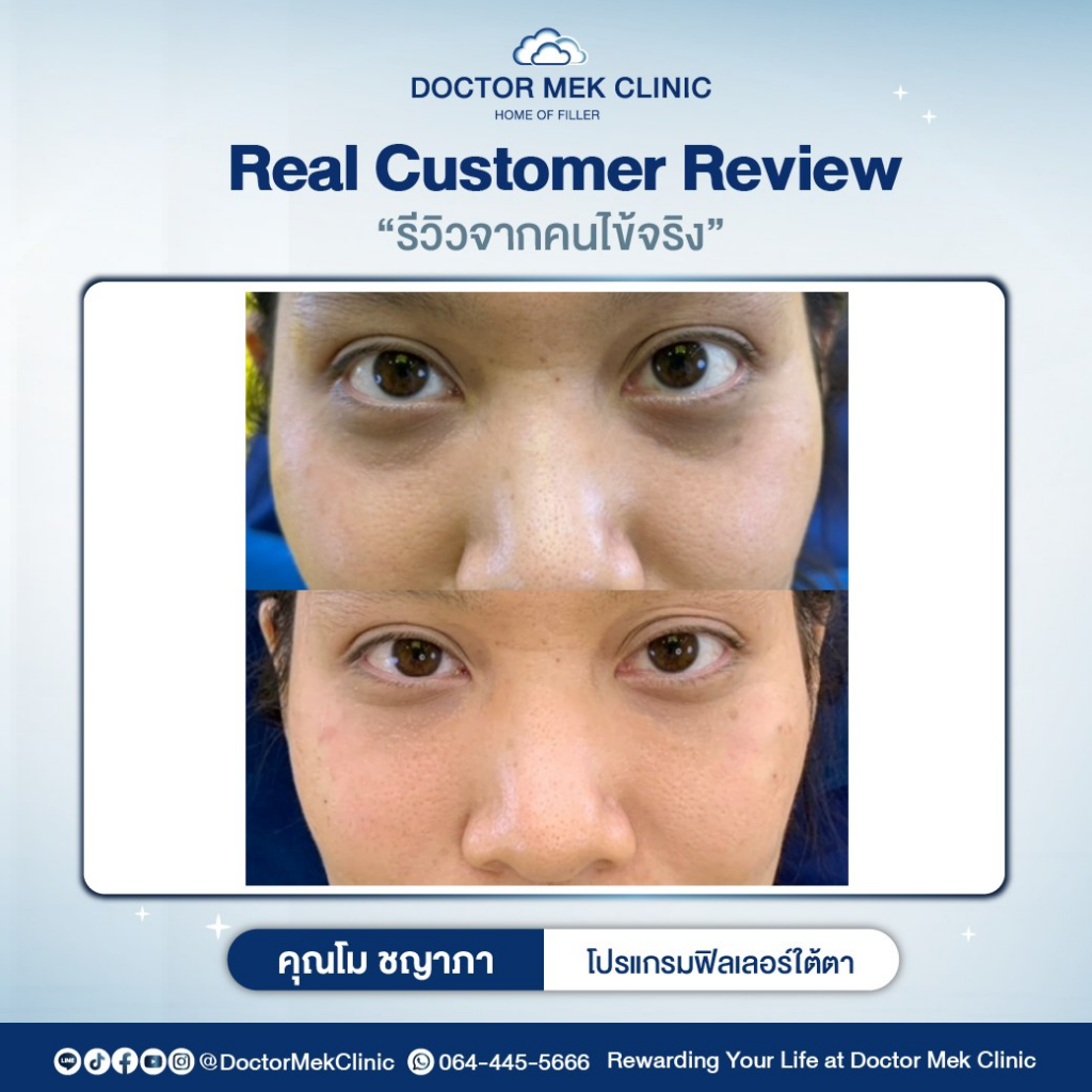 รีวิวฉีดฟิลเลอร์ใต้ตาที่ Doctor Mek Clinic