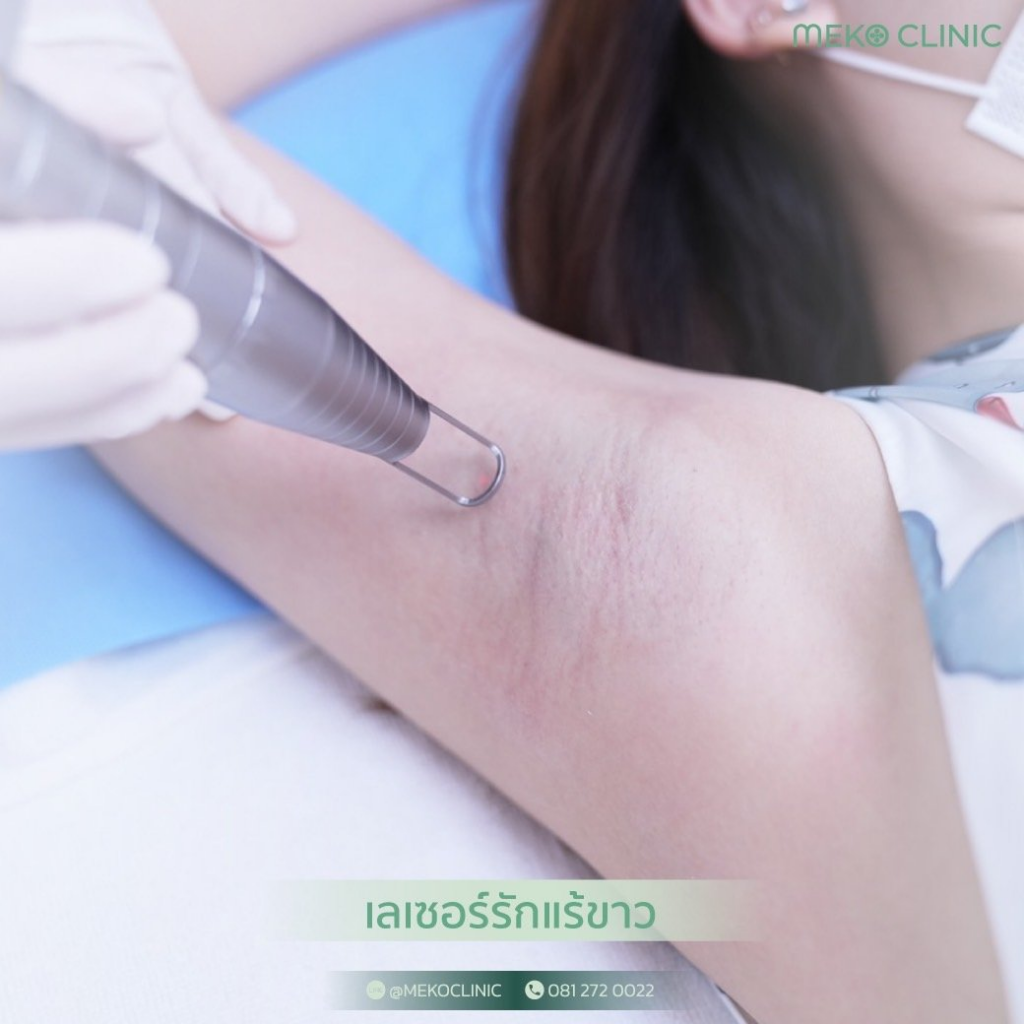 รีวิวเลเซอร์ขนรักแร้ที่ Meko Clinic
