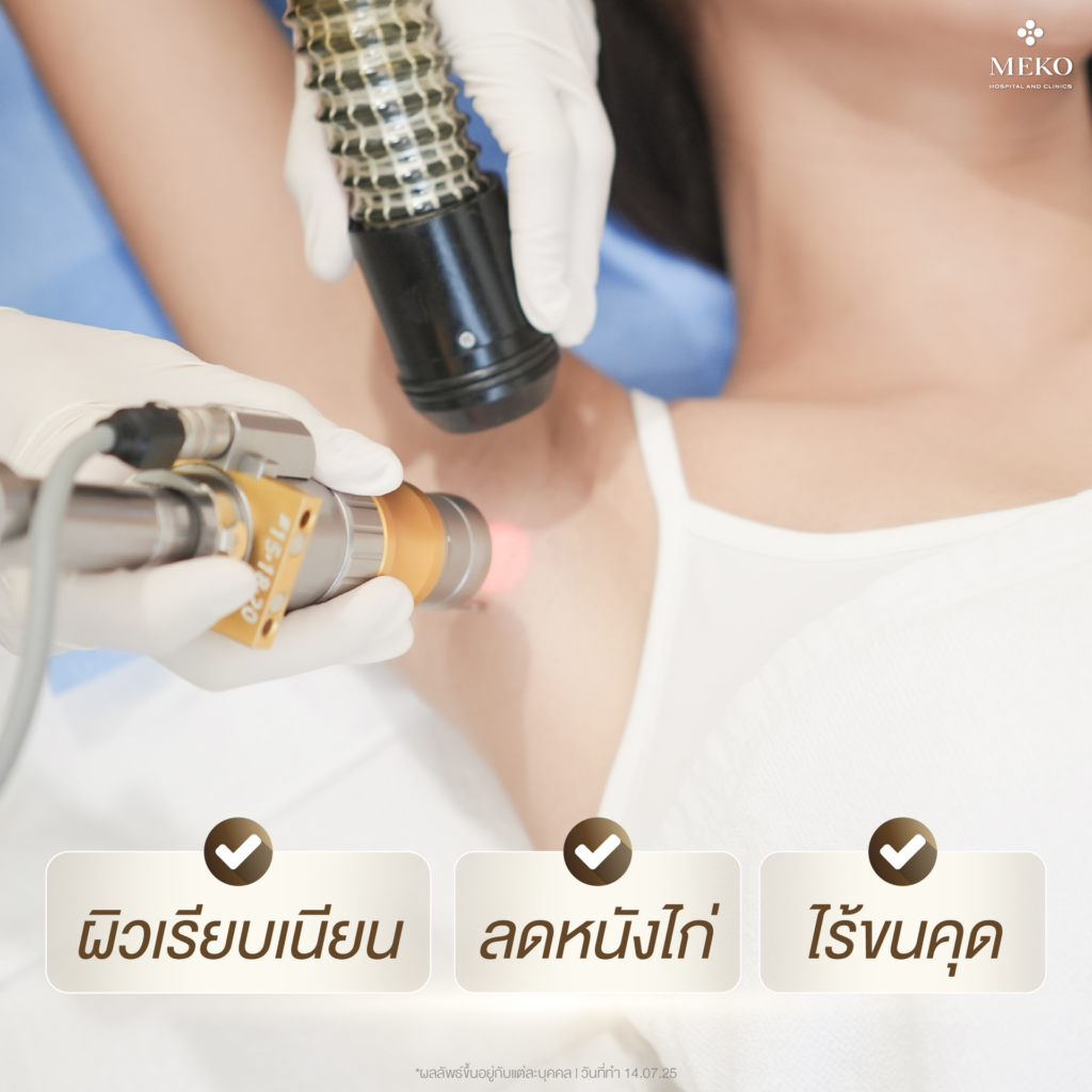 รีวิวเลเซอร์ขนรักแร้ที่ Meko Clinic