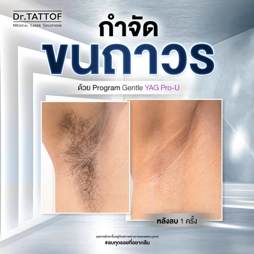 รีวิวเลเซอร์ขนรักแร้ที่ Dr. TATTOF Clinic