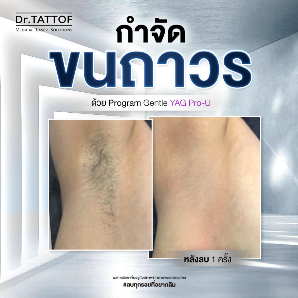 รีวิวเลเซอร์ขนรักแร้ที่ Dr. TATTOF Clinic
