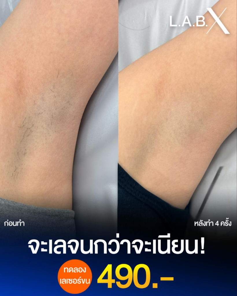 รีวิวเลเซอร์ขนรักแร้ที่ LabX Clinic
