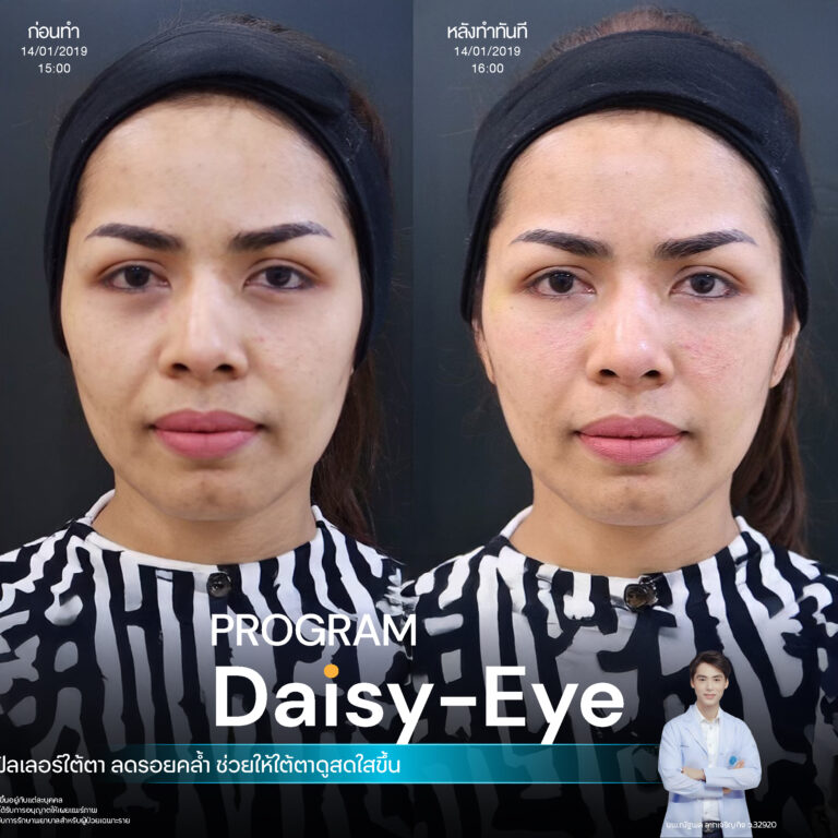 รีวิวฉีดฟิลเลอร์ใต้ตาที่ Infiniz Clinic