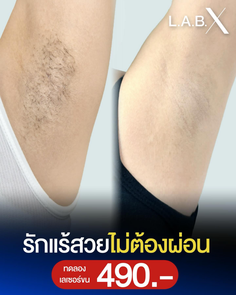 รีวิวเลเซอร์ขนรักแร้ที่ LabX Clinic