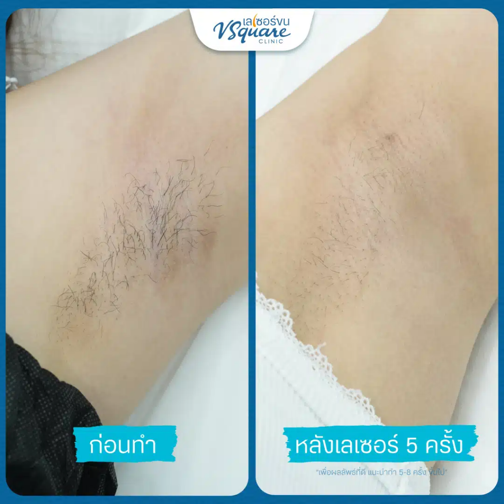 รีวิวเลเซอร์ขนรักแร้ที่ V Square Clinic
