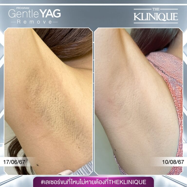 รีวิวเลเซอร์ขนรักแร้ที่ The Klinique