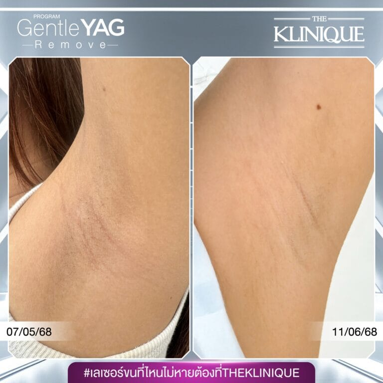 รีวิวเลเซอร์ขนรักแร้ที่ The Klinique