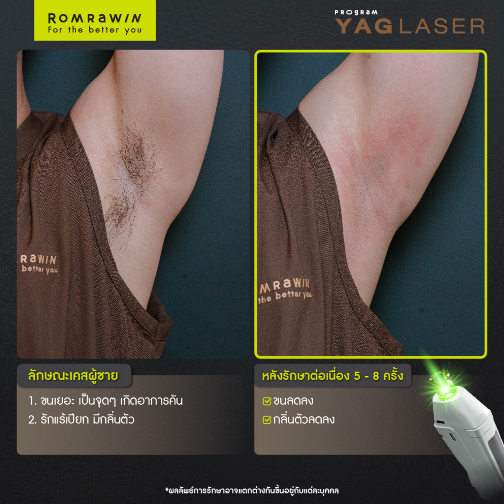 รีวิวเลเซอร์ขนรักแร้ที่ Romrawin Clinic