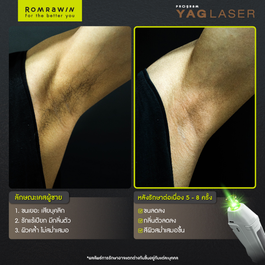 รีวิวเลเซอร์ขนรักแร้ที่ Romrawin Clinic