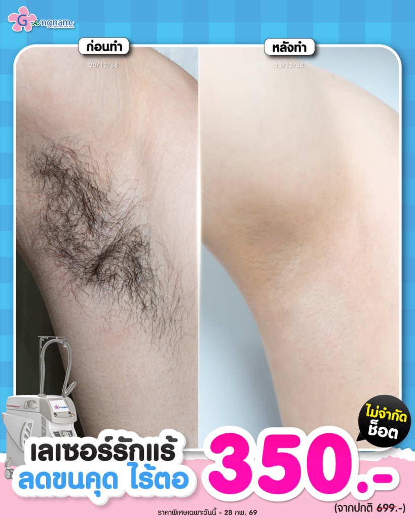 รีวิวเลเซอร์ขนรักแร้ที่ Gangnam Clinic