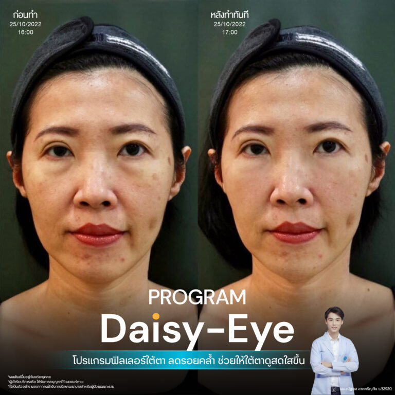 รีวิวฉีดฟิลเลอร์ใต้ตาที่ Infiniz Clinic