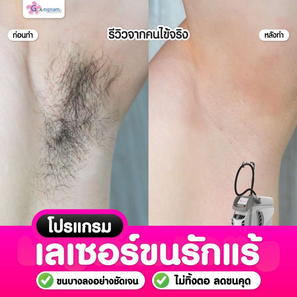 รีวิวเลเซอร์ขนรักแร้ที่ Gangnam Clinic