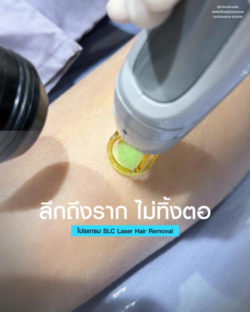 รีวิวเลเซอร์ขนรักแร้ที่ SLC Clinic