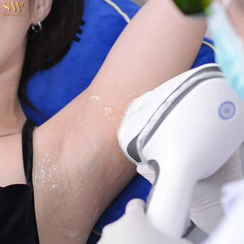 รีวิวเลเซอร์ขนรักแร้ที่ Sowon Clinic