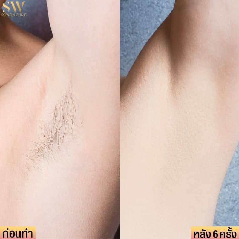 รีวิวเลเซอร์ขนรักแร้ที่ Sowon Clinic