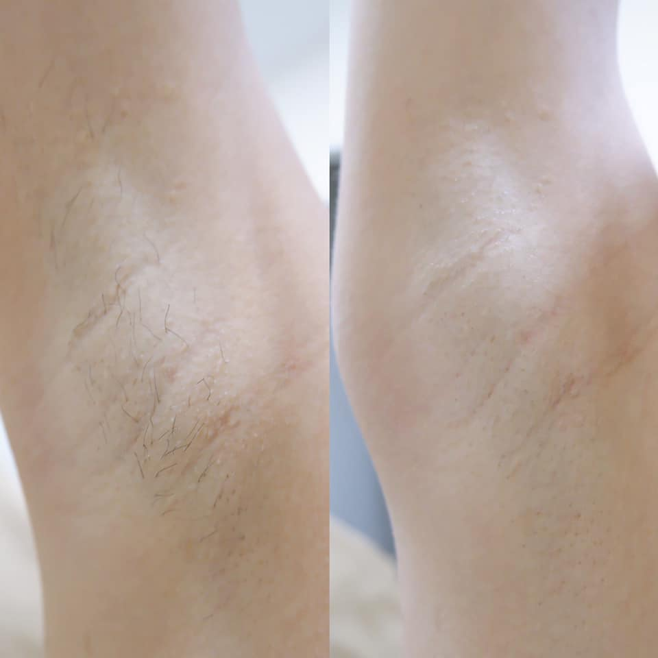 รีวิวเลเซอร์ขนรักแร้ที่ Patcha Clinic