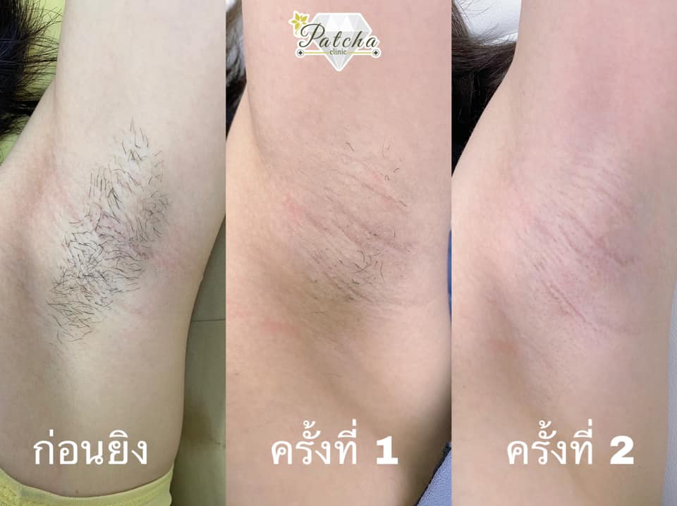 รีวิวเลเซอร์ขนรักแร้ที่ Patcha Clinic