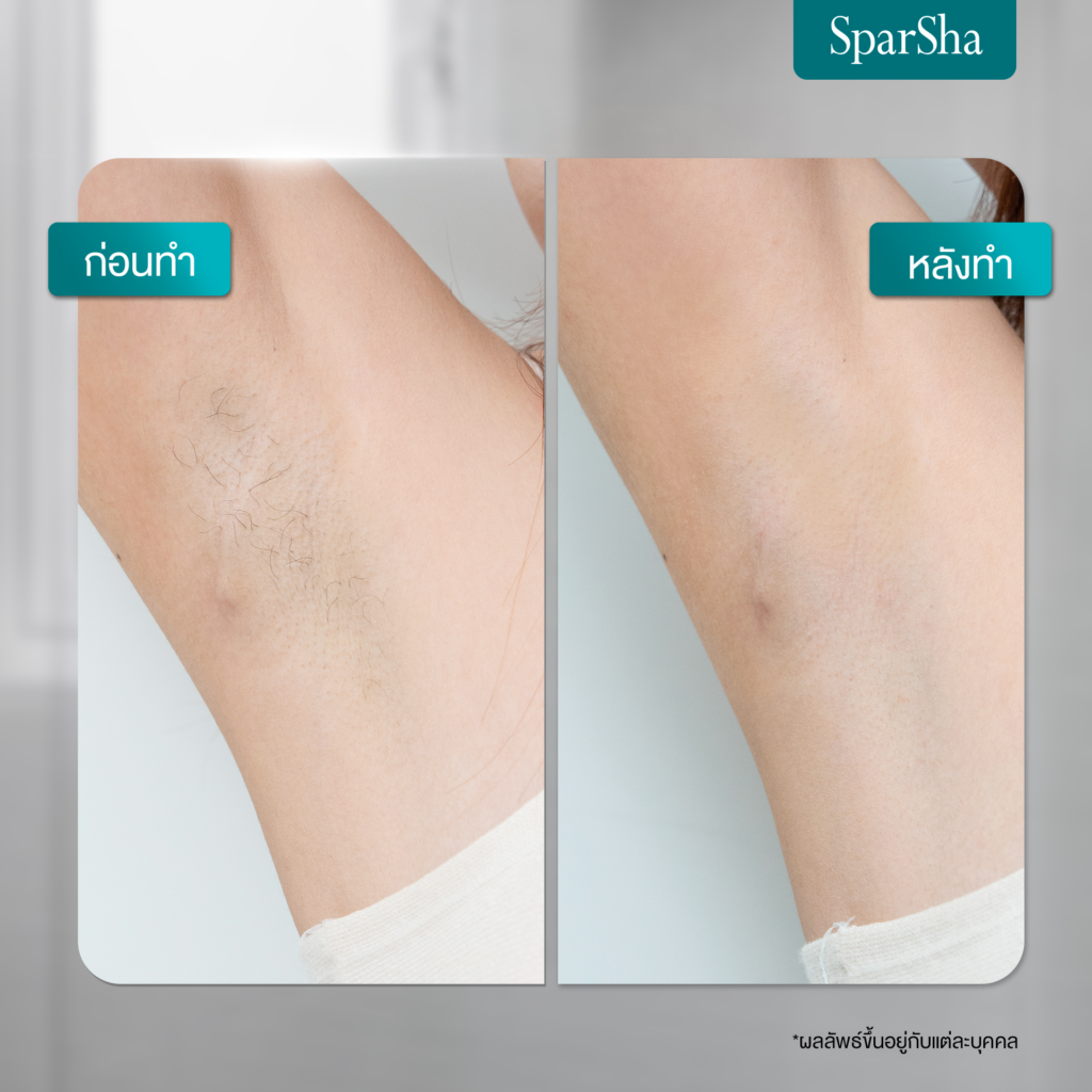 รีวิวเลเซอร์ขนรักแร้ที่ Sparsha