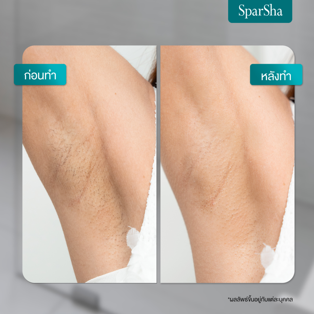 รีวิวเลเซอร์ขนรักแร้ที่ Sparsha