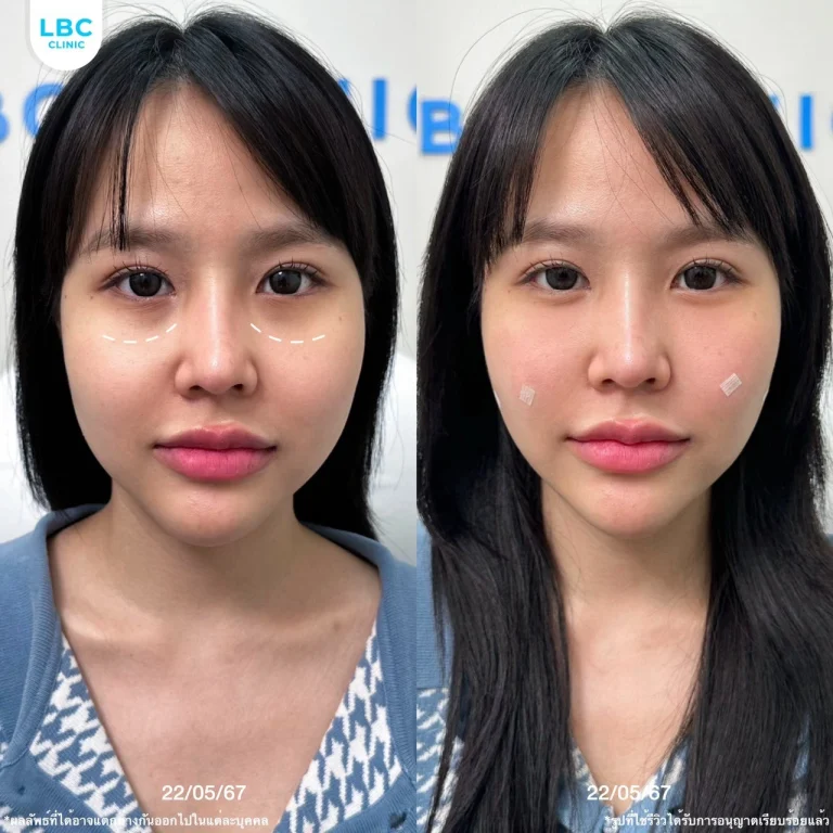 รีวิวฉีดฟิลเลอร์ใต้ตาที่ LBC Clinic