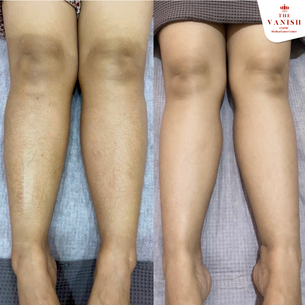รีวิวเลเซอร์ขนขาที่ The Vanish Clinic