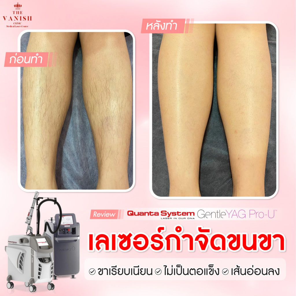 รีวิวเลเซอร์ขนขาที่ The Vanish Clinic