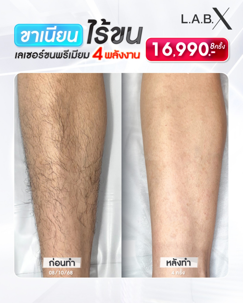 รีวิวเลเซอร์ขนขาที่ Lab X Clinic