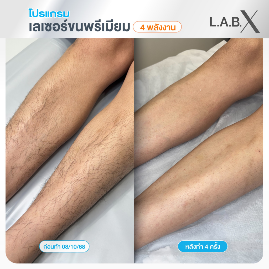 รีวิวเลเซอร์ขนขาที่ Lab X Clinic